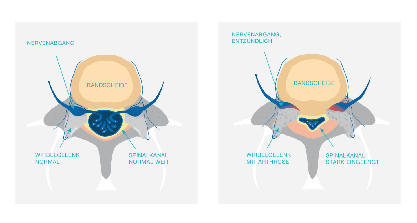 Infografik Darstellung Wirbelkanalverengung