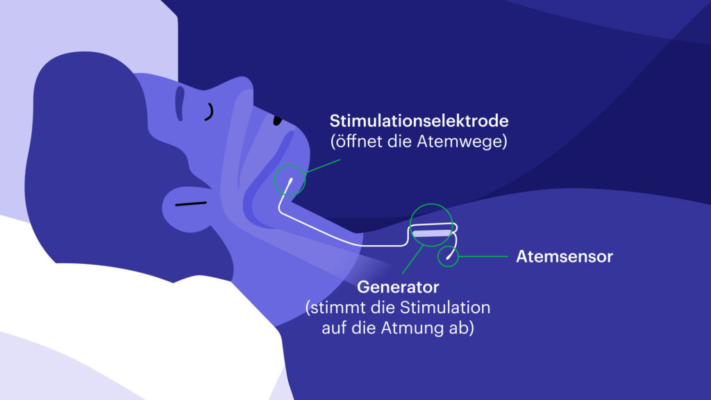 Schematische Darstellung von der Implantation eines Zungenschrittmachers bei Schlafapnoe