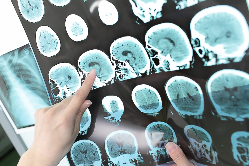 Röntgenbild Radiologie Schlaganfall