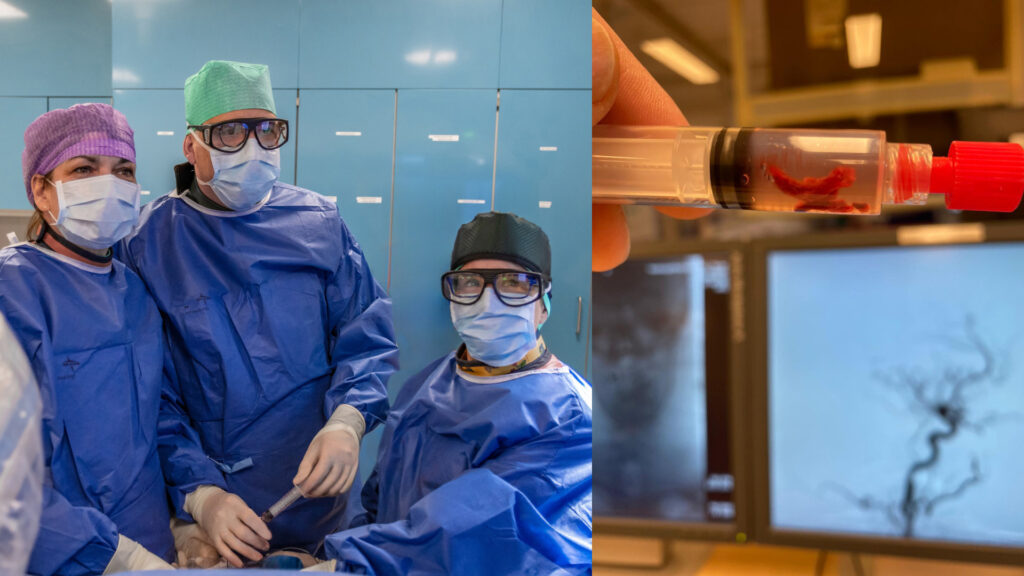 Bildmontage: links eine Ärztin, ein Arzt und eine Schwester der Neuroradiologie an den Sana Kliniken Leipziger Land bei der Katheterbehandlung eines Schlaganfallpatienten; rechts eine Nahaufnamhe des bei dem Eingriff entfernten Blutgerinnsels.