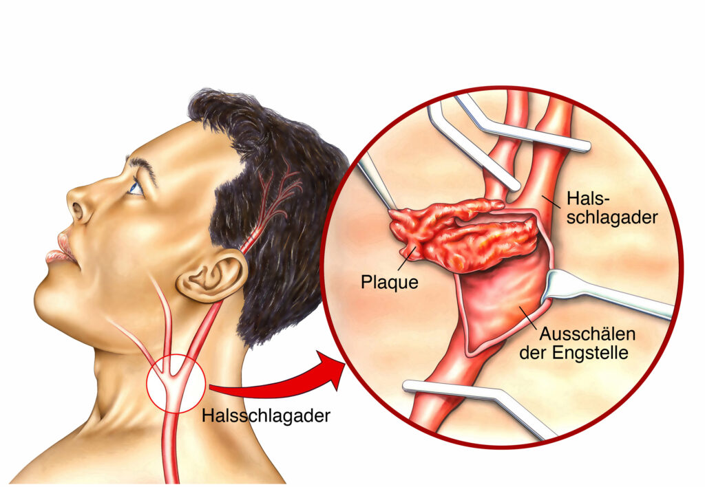 Schematische Darstellung einer durch Plaques verengten Halsschlagader